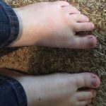 foot - after 12 treatments