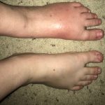 Treatment for CRPS Begins