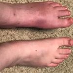 Complex Regional Pain Syndrome (CRPS)